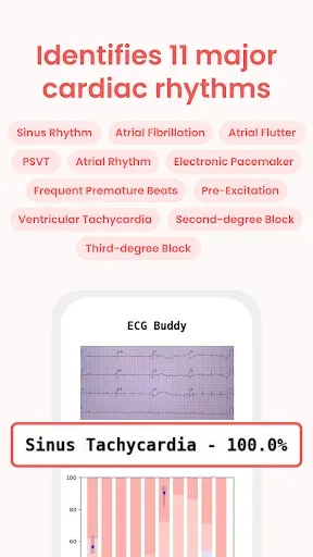 Скриншот 3 — ECG Buddy | ECG Analysis AI