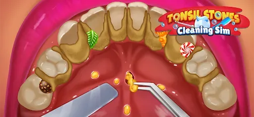 Скриншот 4 — Tonsil Stones Simulator
