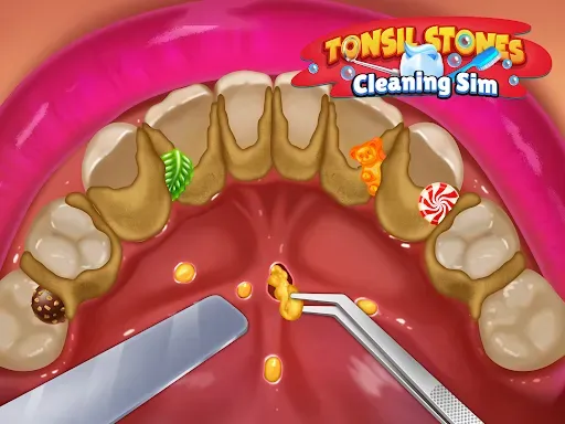 Скриншот 7 — Tonsil Stones Simulator