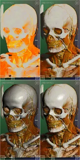 Скриншот 2 — DroidRender - 3D DICOM viewer