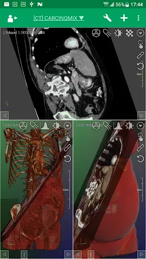 Скриншот 5 — DroidRender - 3D DICOM viewer