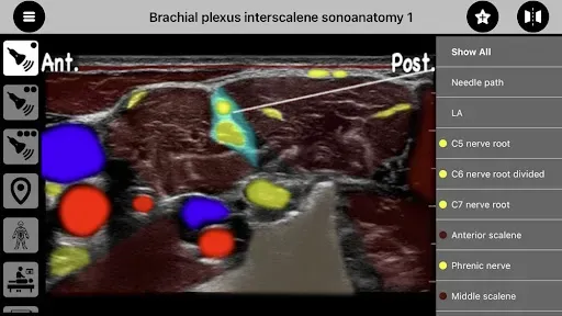 Скриншот 1 — AnSo Anaesthesia Sonoanatomy